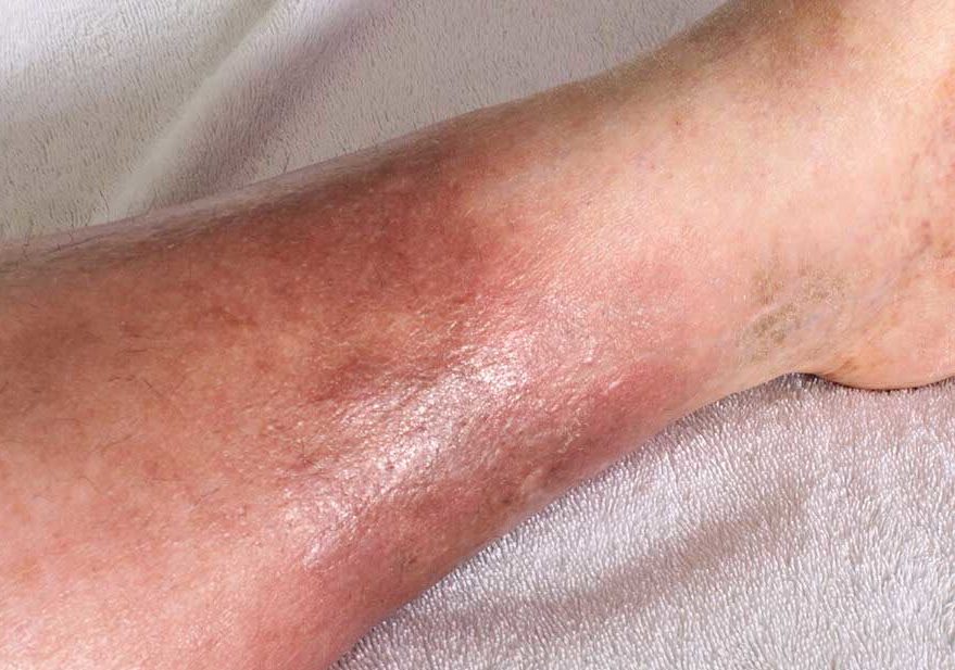 cellulitis treatment